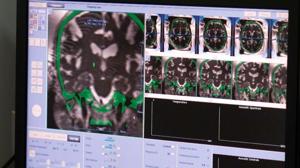 Neurosurgeons are using a noninvasive brain surgery to treat essential tremor, depression and other conditions. Here’s how it works.